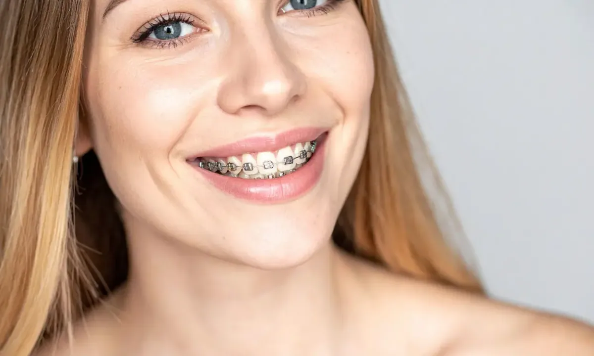 How Do Braces Work? - BP Smiles Orthodontics, Queens NY