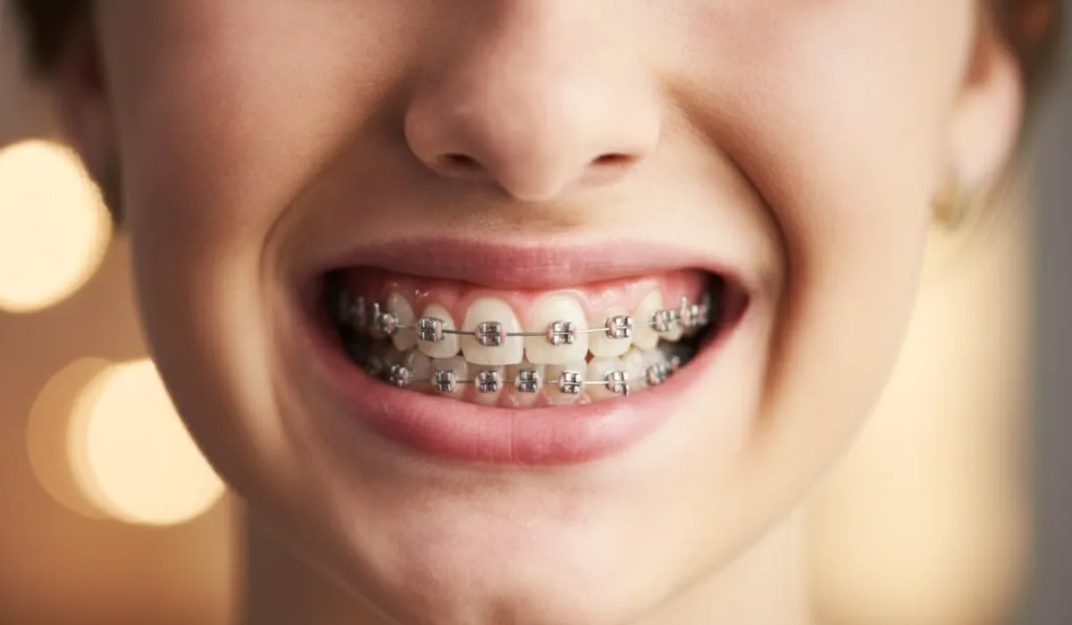 How Long Do Braces Take? Treatment Timeline for Queens Patients (2026) - BP Smiles Orthodontics, Queens NY