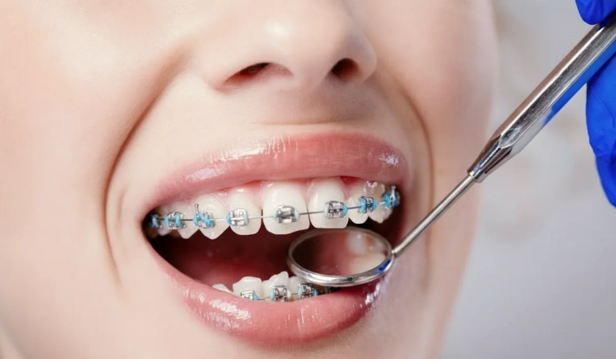 How Much Do Braces Cost? Price Guide for Queens Families (2026) - BP Smiles Orthodontics, Queens NY