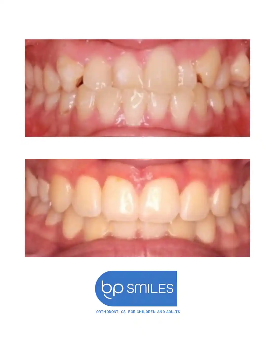 Orthodontic treatment before and after results - case 11 at BP Smiles