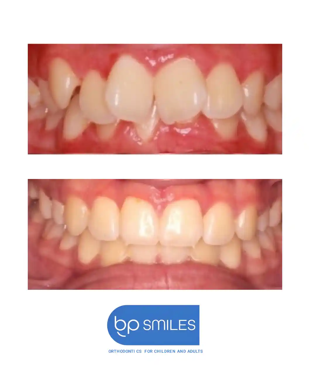 Orthodontic treatment before and after results - case 14 at BP Smiles