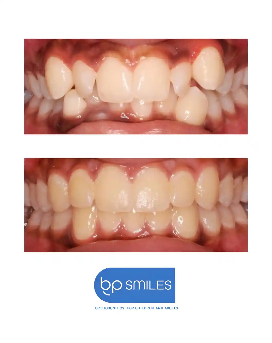 Orthodontic treatment before and after results - case 2 at BP Smiles