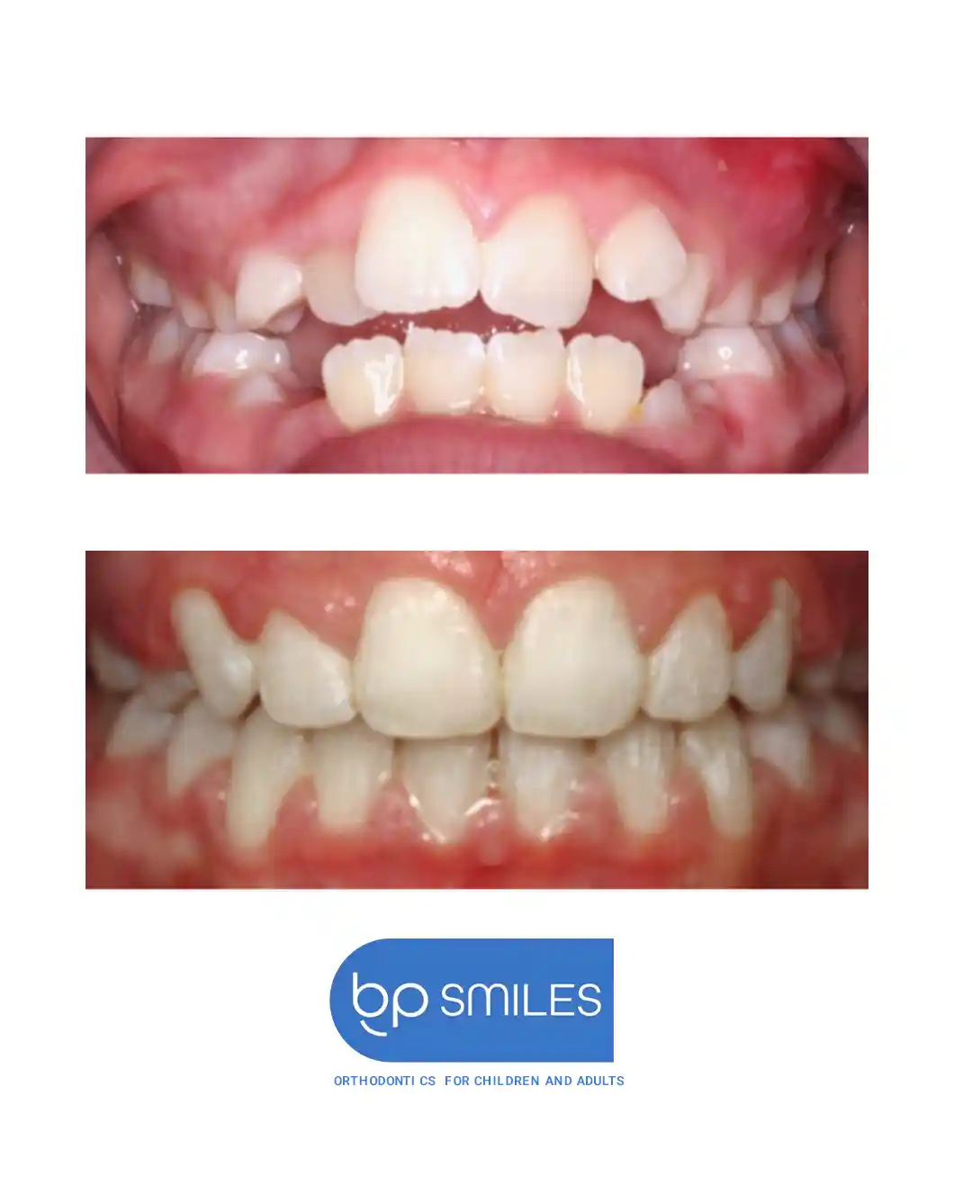 Orthodontic treatment before and after results - case 3 at BP Smiles