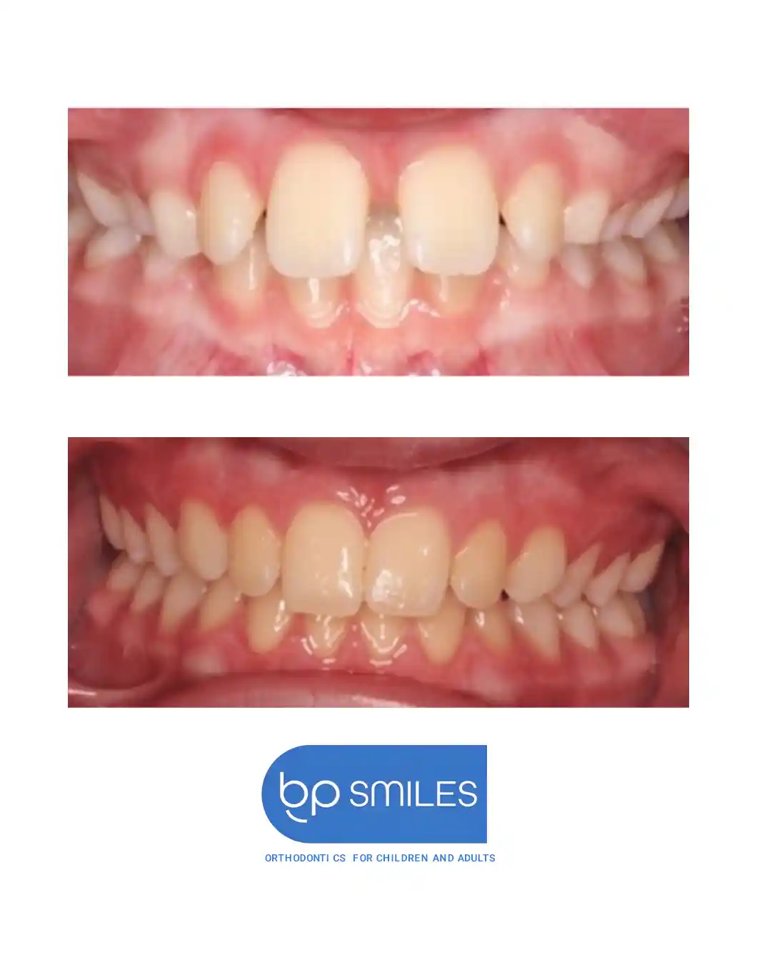 Orthodontic treatment before and after results - case 4 at BP Smiles