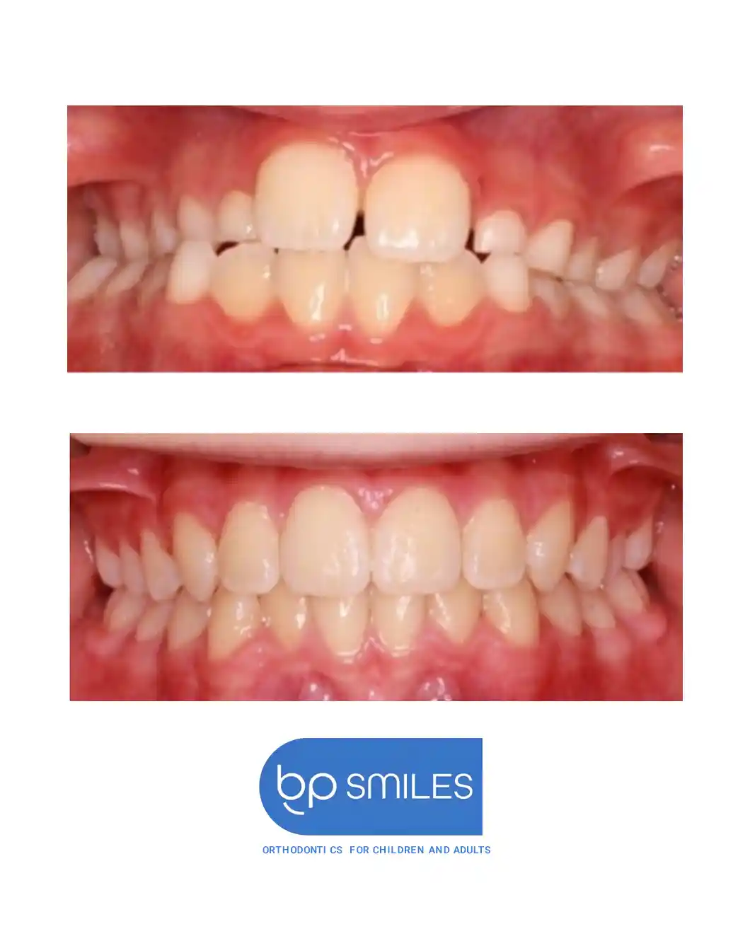 Orthodontic treatment before and after results - case 5 at BP Smiles
