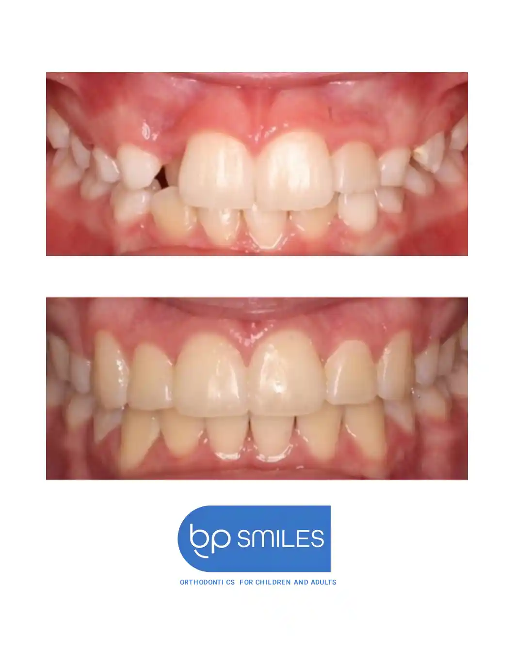 Orthodontic treatment before and after results - case 6 at BP Smiles
