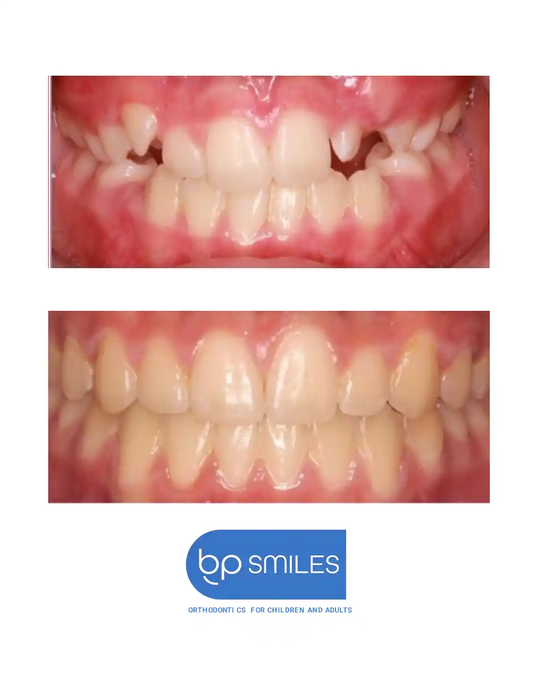 Orthodontic treatment before and after results - case 7 at BP Smiles