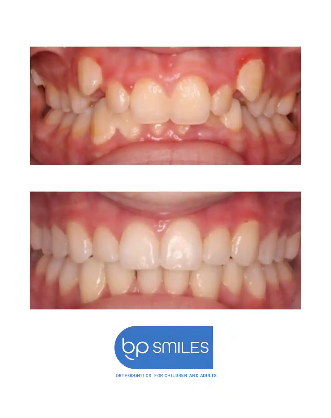 Orthodontic treatment before and after results - case 8 at BP Smiles