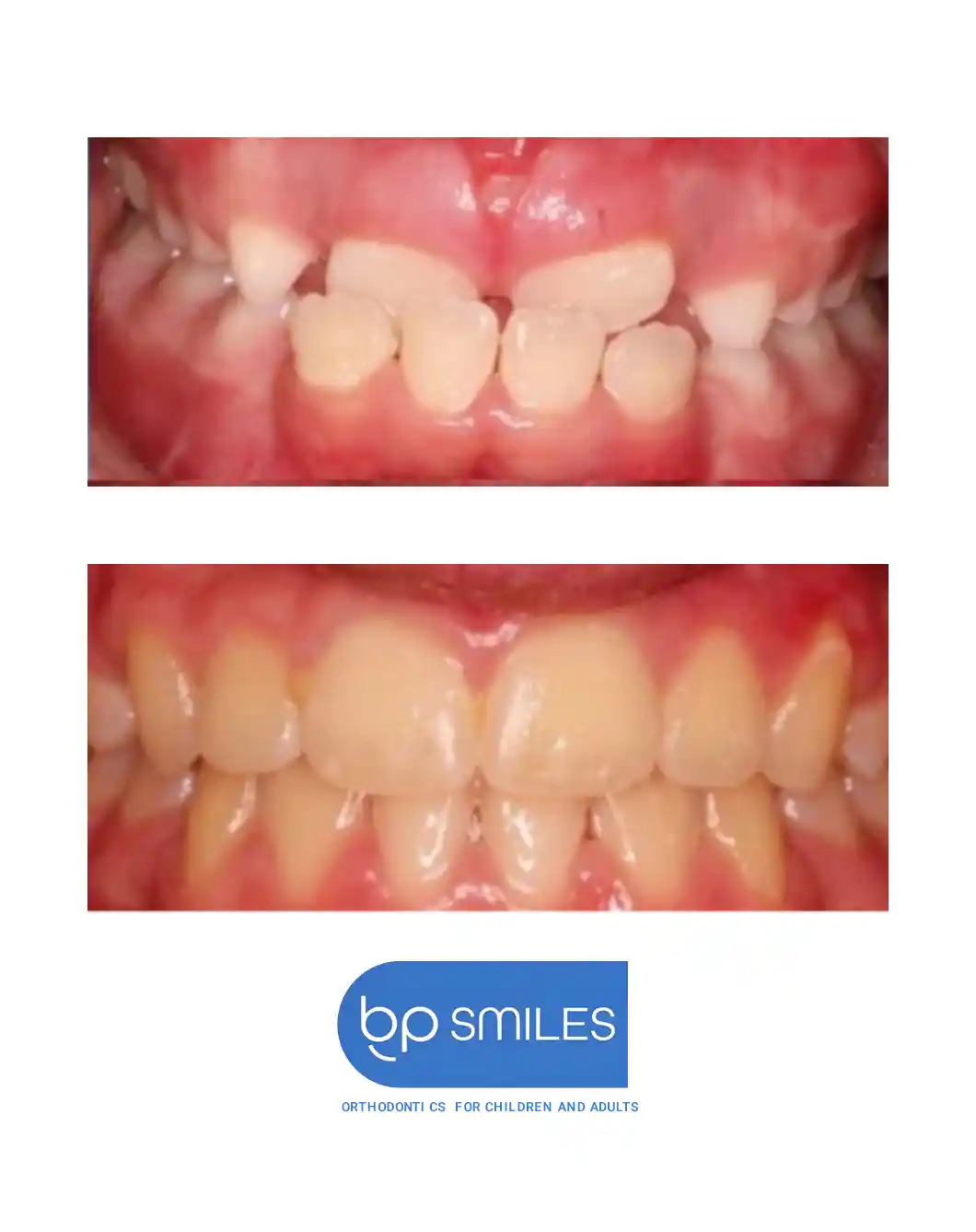 Orthodontic treatment before and after results - case 9 at BP Smiles