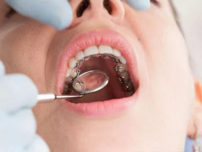Sistema de ortodoncia Brava en BP Smiles