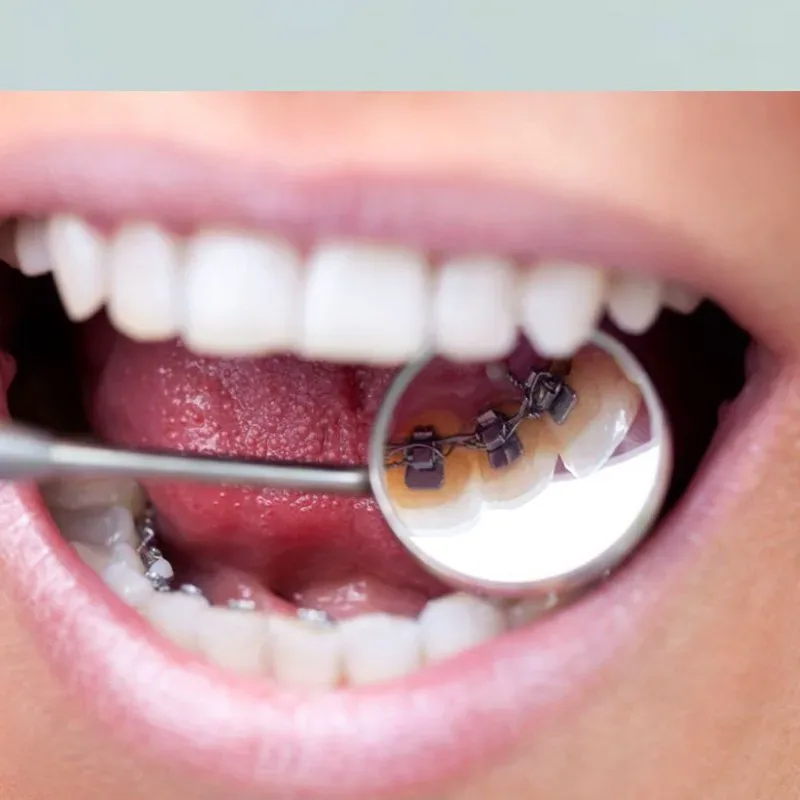 Cost of Invisalign in Queens, NY
