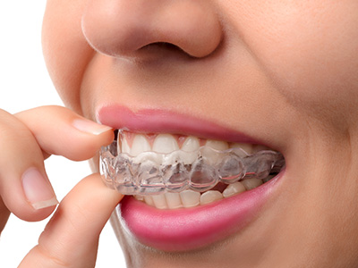 bp smiles | Interceptive Orthodontics, Types of  Braces and Teeth Whitening