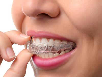 bp smiles | Our Dental Technology, Surgical Orthodontics and Invisalign reg 