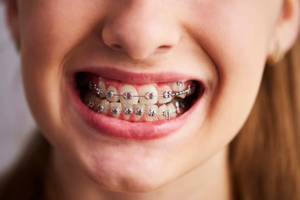 Can You Get Braces If You Have a Crown