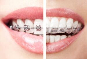 Invisalign vs. Braces