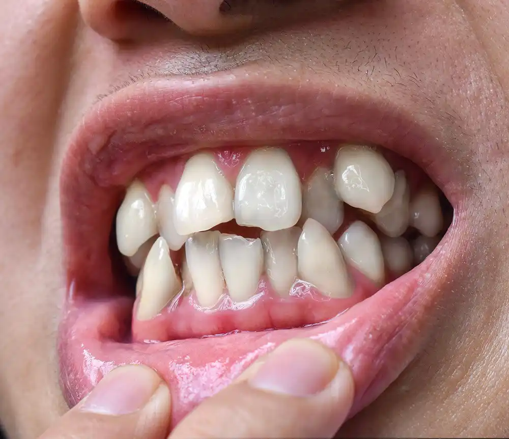 Who Is a Good Candidate for Braces