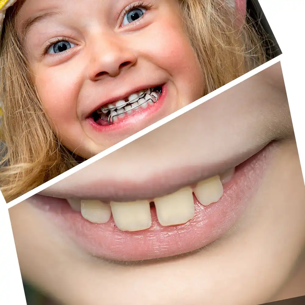 Orthodontics for Children