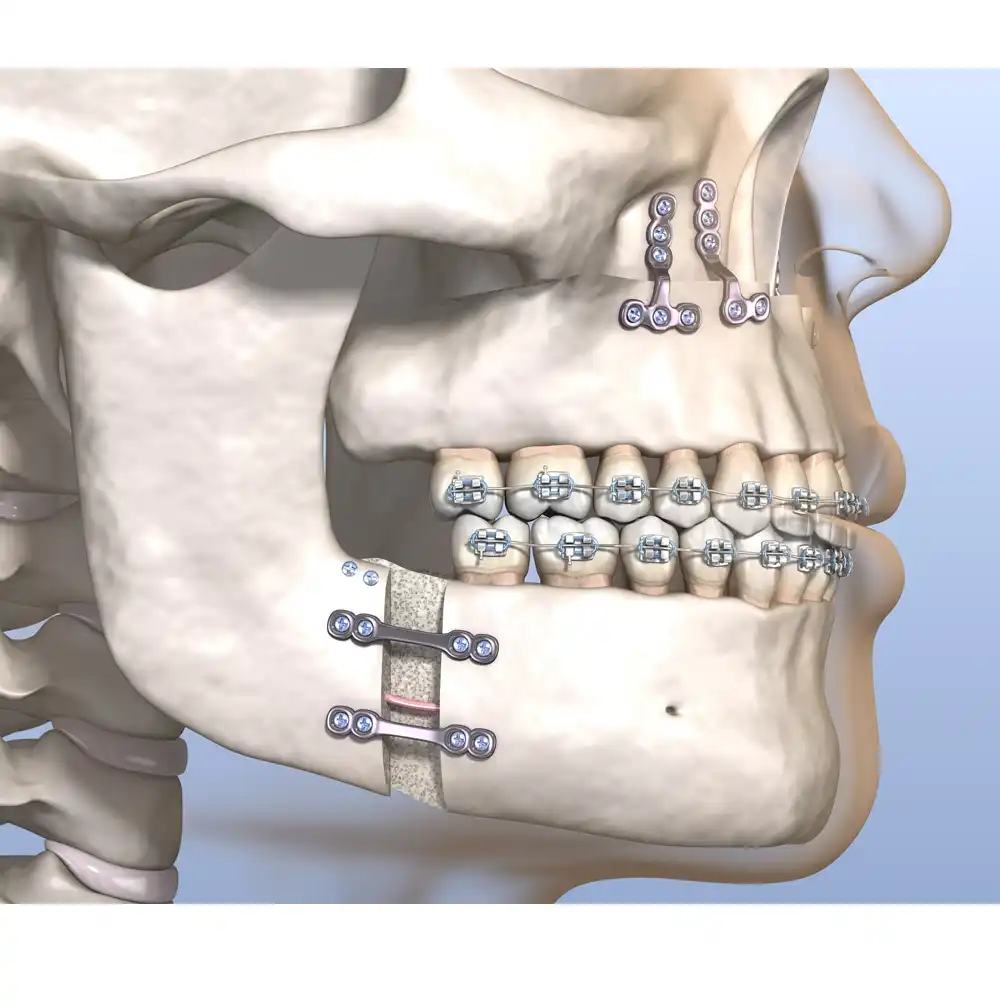 Surgical Orthodontics