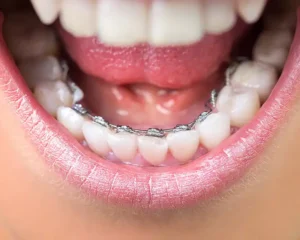 Lingual Braces