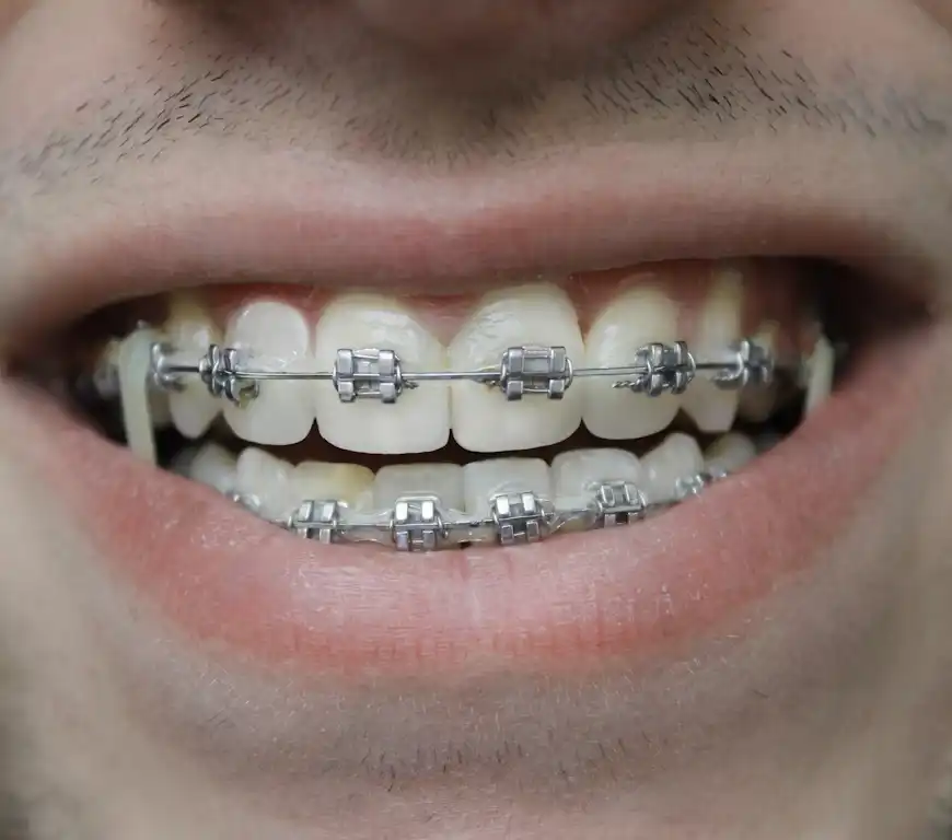 Traditional Metal Braces