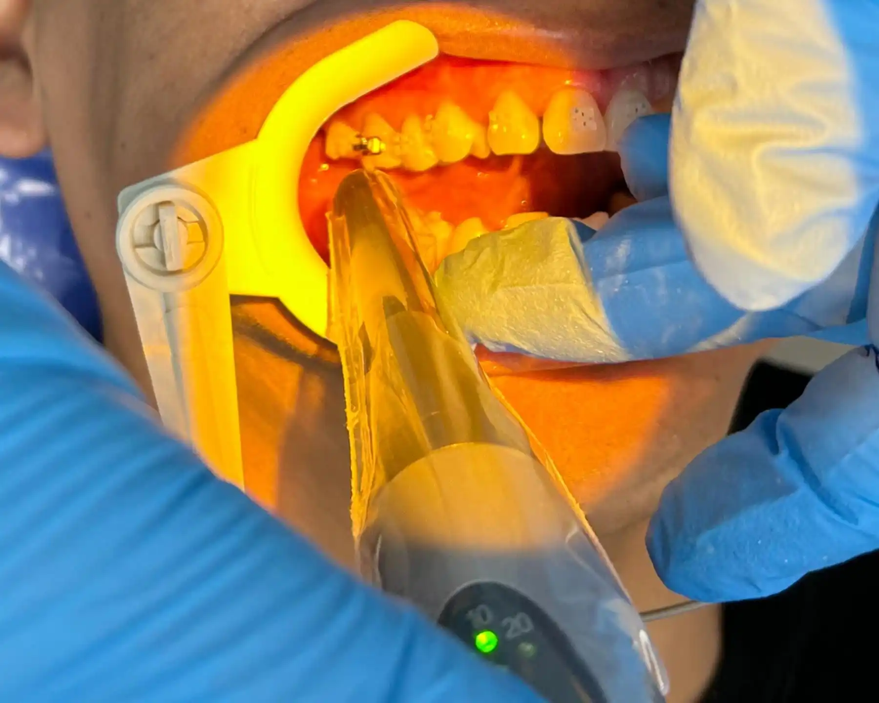 Orthodontics for Children in Queens, NY