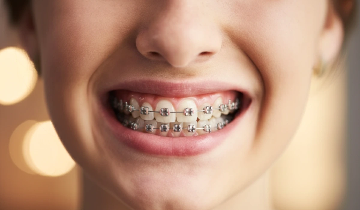 A close-up shot of a teenager smiling with metal braces, providing a visual reference for patients wondering how long do braces take to straighten teeth and achieve a perfect smile.