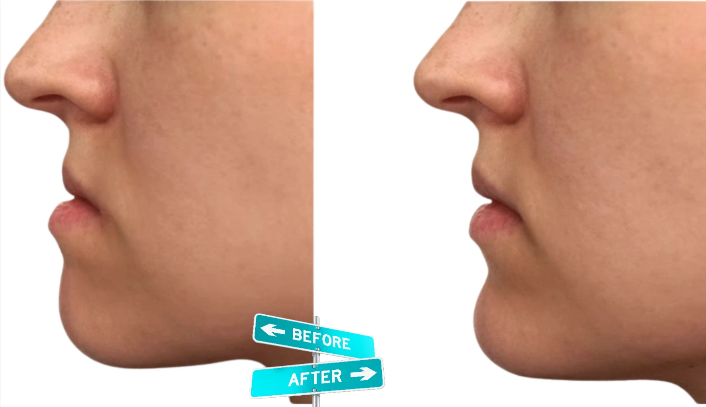 Side-by-side comparison showing how orthodontic treatment addresses a recessed chin and overbite to answer the common question: can braces fix your jawline?