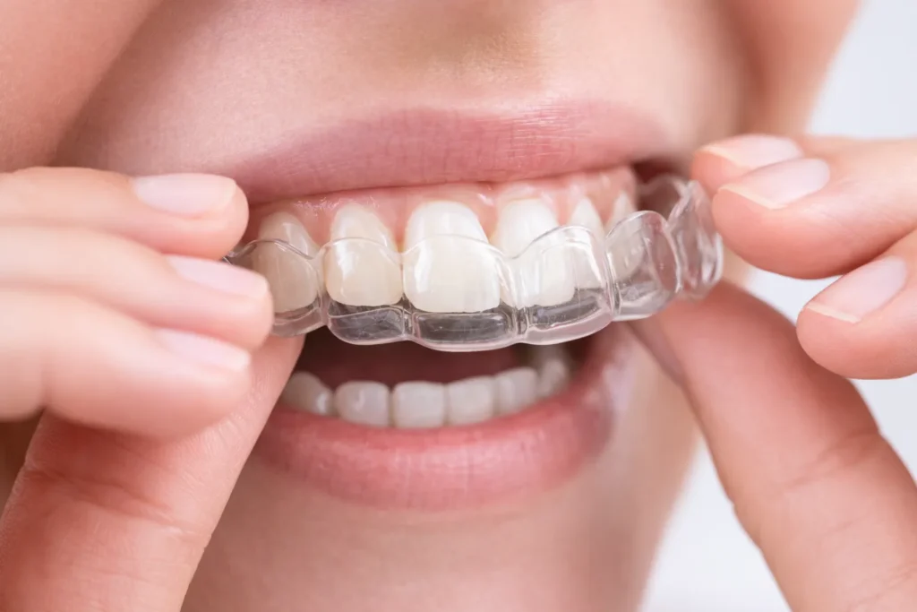 Patient placing a clear Invisalign aligner over teeth with dental crowns and veneers
